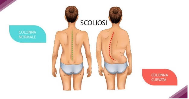 Scoliosi