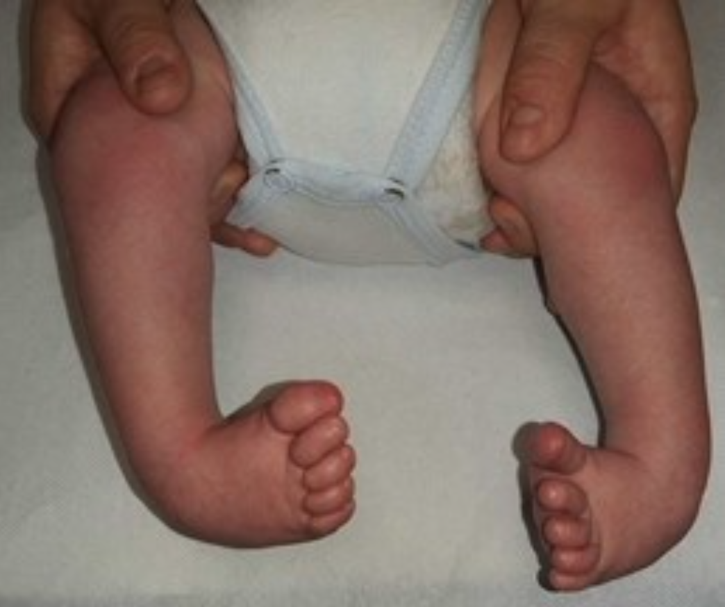 Piede torto congenito