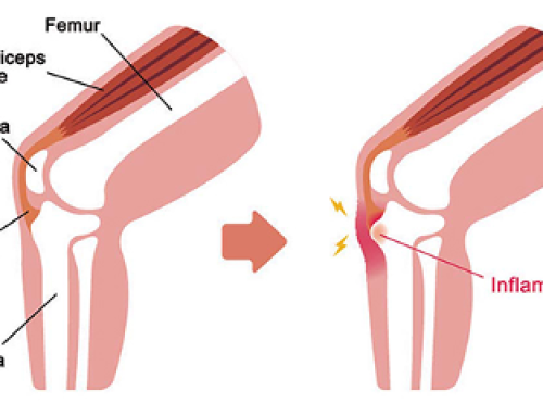 Osteocondrosi